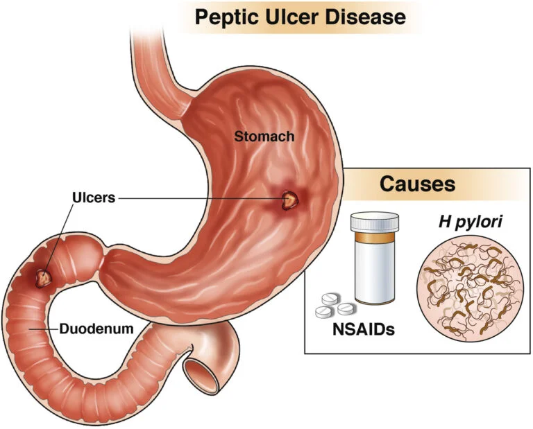 Stomach Ulcer